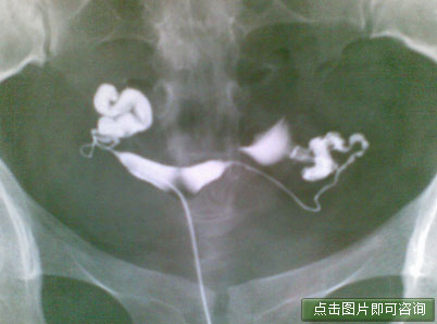 输卵管扭曲